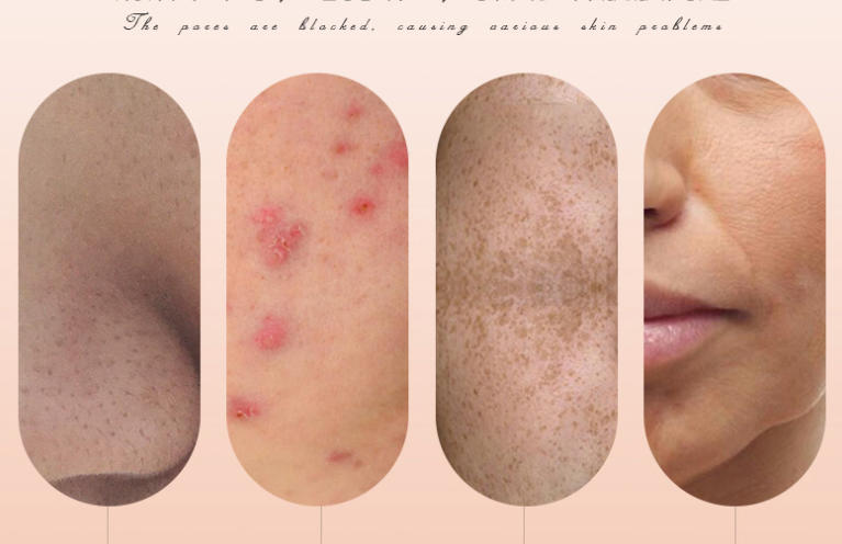 Electric Blackhead Remover